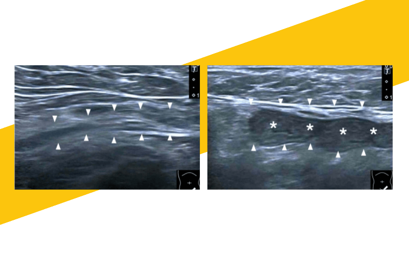 6. Hernia inguinal indirecta ecografia tempo formacion.png